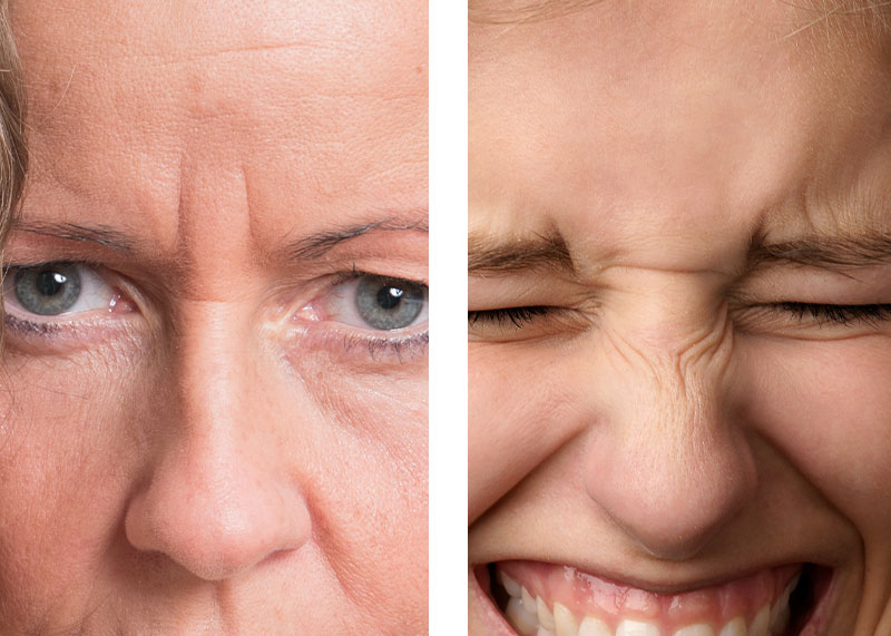 faltenbehandlung mit einem muskelrelaxans augen augenklinik sulzbach
