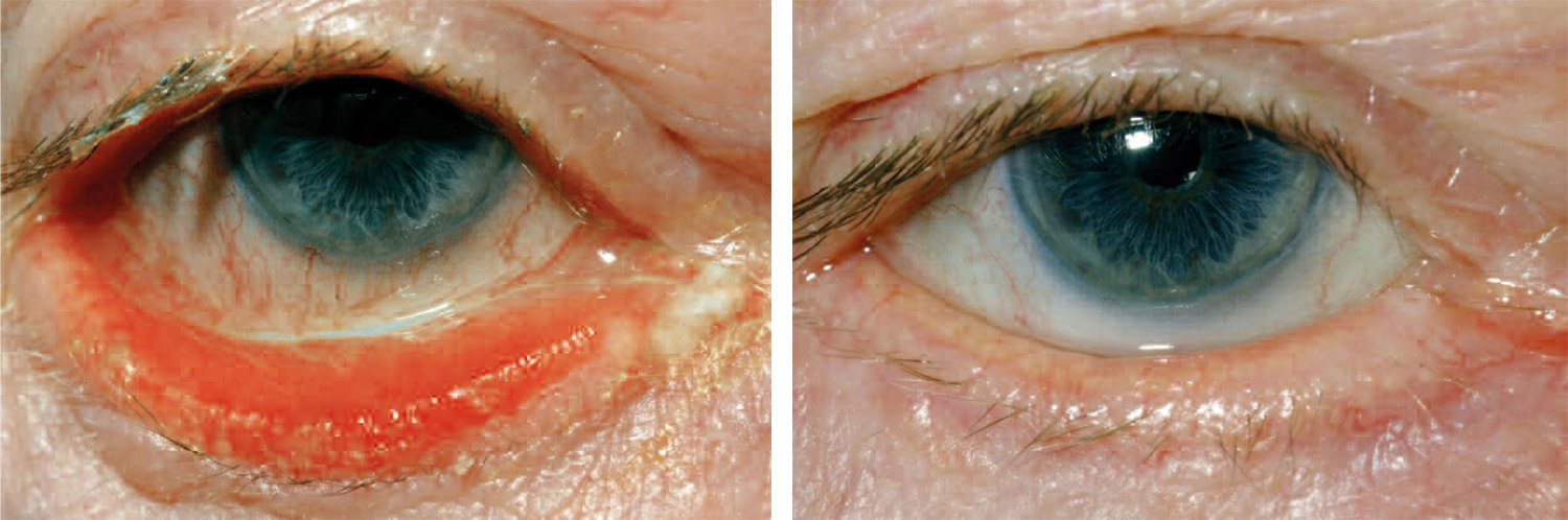Ektropium