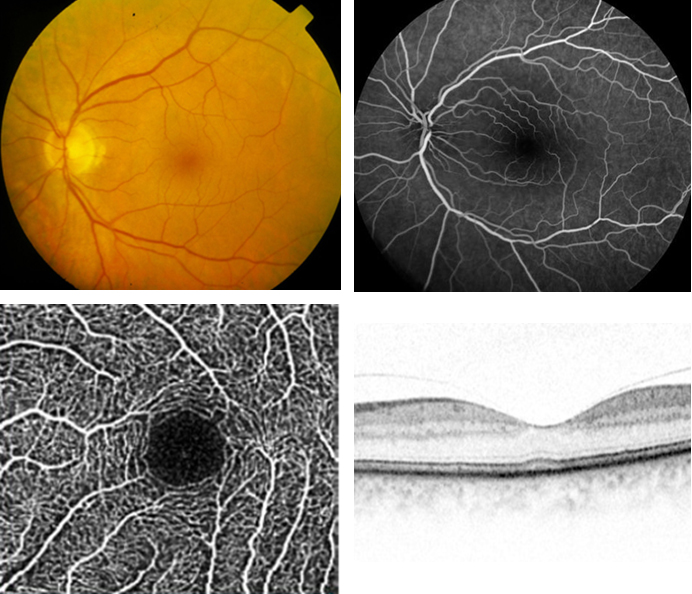 Evolution der Netzhautdiagnostik