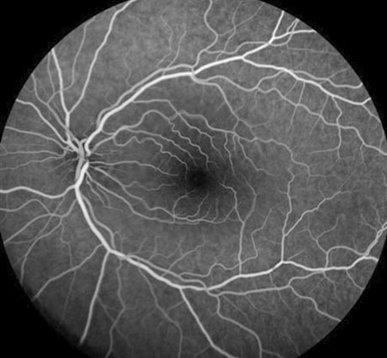 Fluoreszein-Angiographie mit Normalbefund