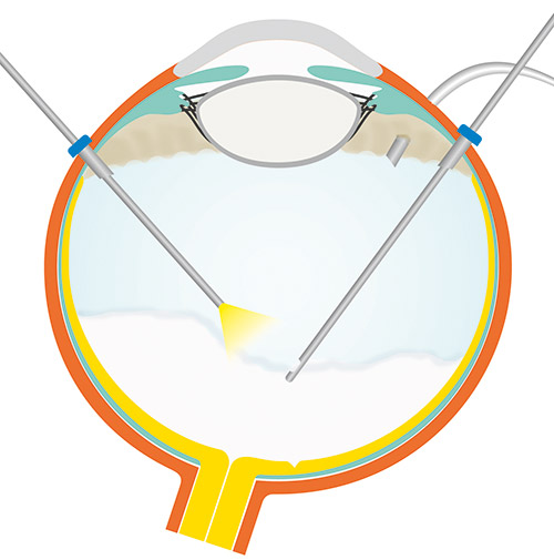 Operation der Uveitis