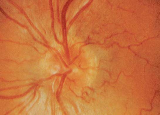 Leber’sche hereditäre Optikusneuropathie