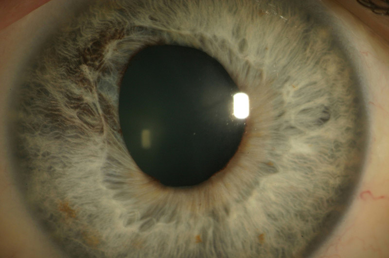 Herpes Uveitis