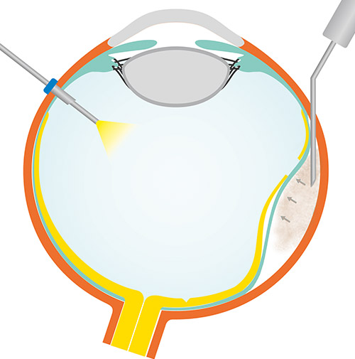 Hydrogel-Plombe