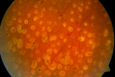 Laserkoagulation bei PDR