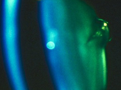 Lenticonus Posterior