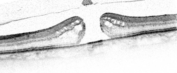 Makulaforamen im OCT