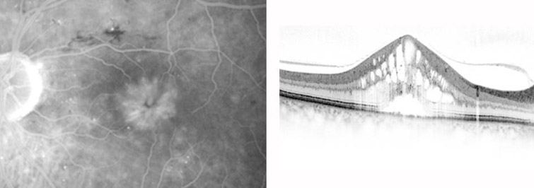 Makulaödem bei Uveitis