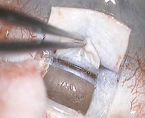 Sulzbacher Kanaloplastik