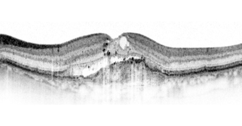 Optische Kohärenztomographie