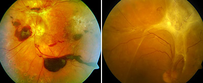 Proliferative Retinopathie